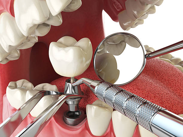 Best Emergency Treatment for Dental Infections or Abscesses in Roselle, IL